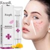 Acne Treatment Face Cream Blackhead Repair Gel Oil Control Shrink Pores Scar Whitening Moisturizer Skin Care Korean Cosmetics