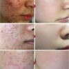 Acne Treatment Face Cream Blackhead Repair Gel Oil Control Shrink Pores Scar Whitening Moisturizer Skin Care Korean Cosmetics